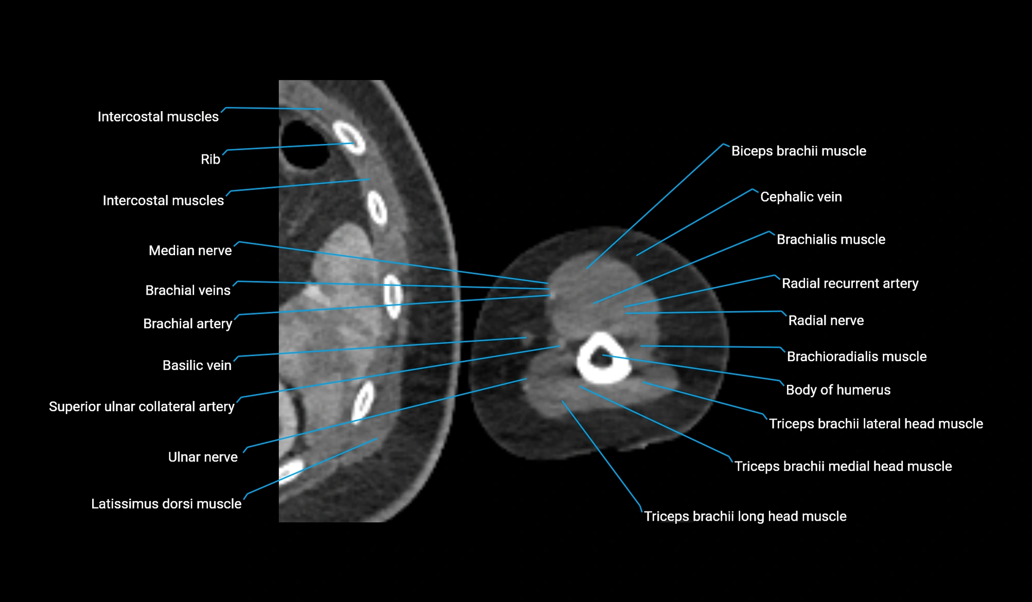 CT upper arm axial  cross sectional anatomy labelled radiology image -00320.webp